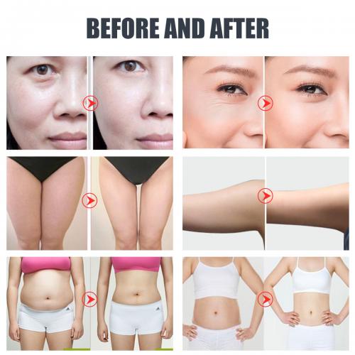 SQ47B Pro, 6in1 40K Cavitation Body Sculpting Device, Multi-Polar RF Vacuum EMS Laser for Body Contouring, Skin Smoothing & Face Skin Firming, US Plug