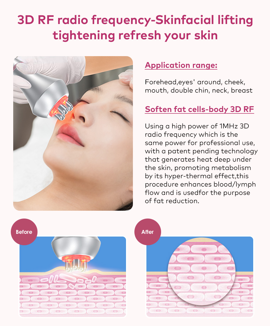3D RF facial lifting