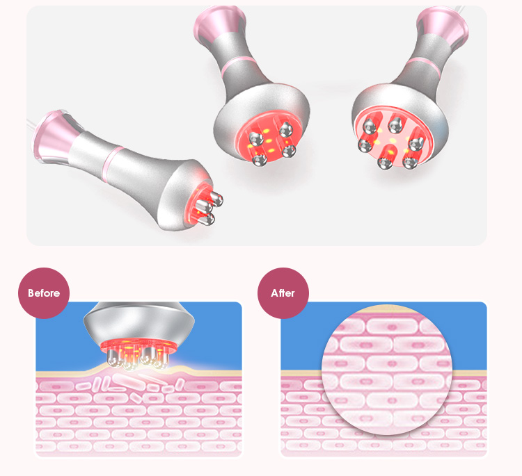 4-Pole RF Probe Face & Neck