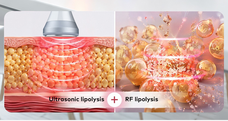 Ultrasonic Lipolysis and RF Lipolysis Technology