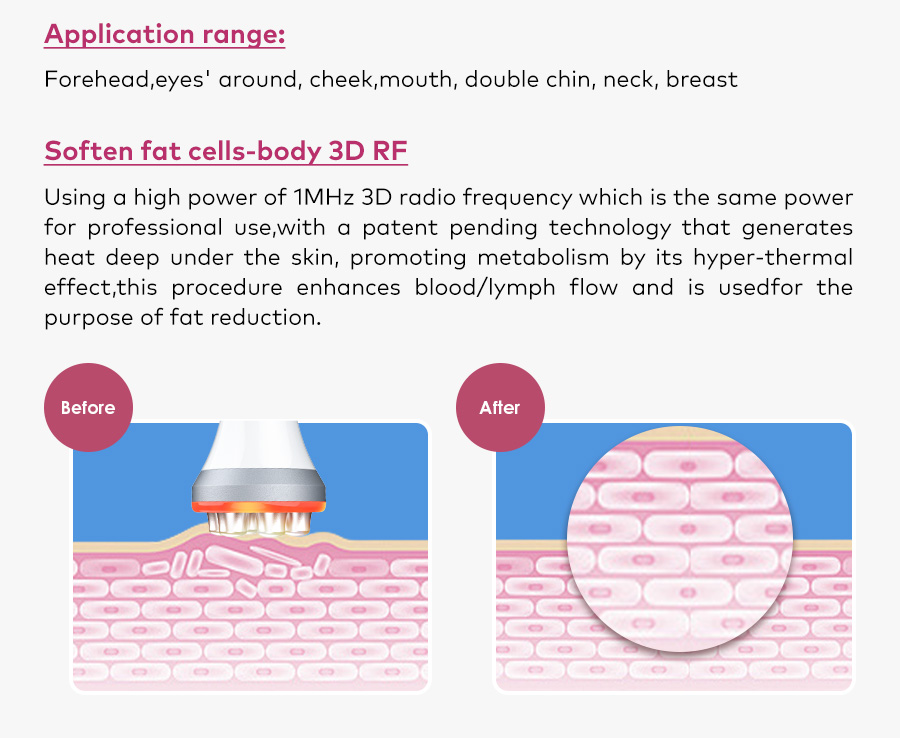 3D RF Before and After