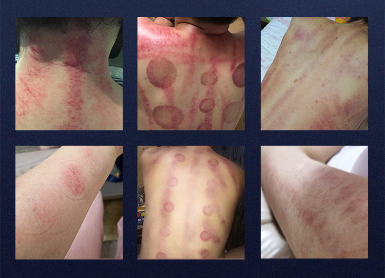 Vacuum Massage Effect