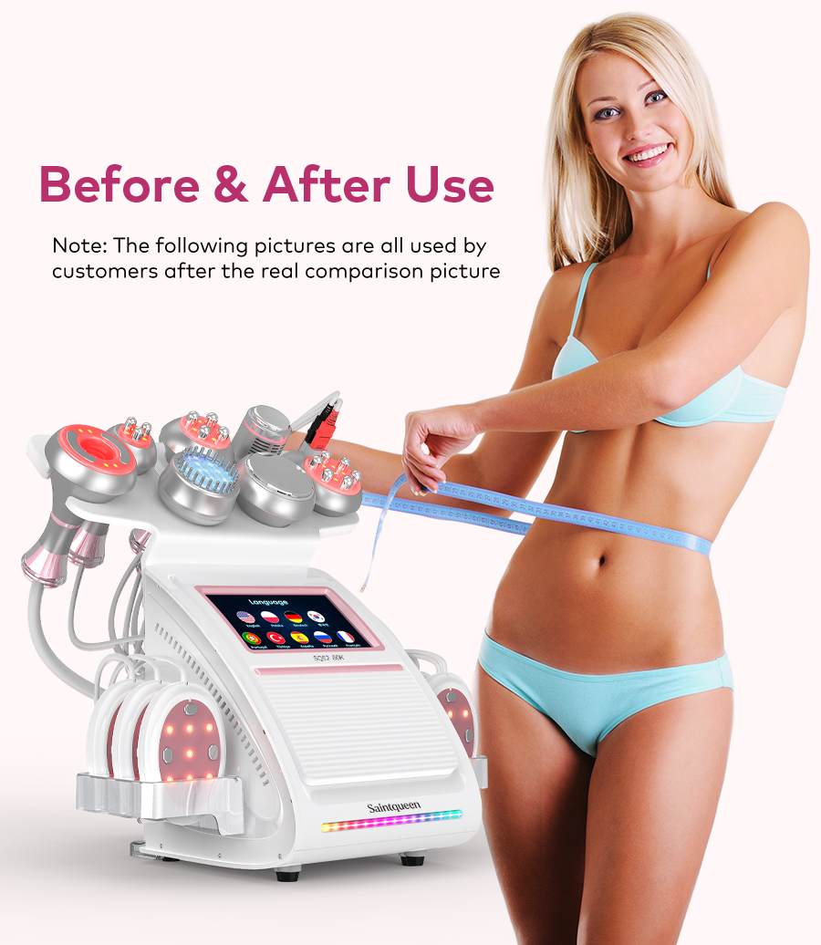 Skin tightening results